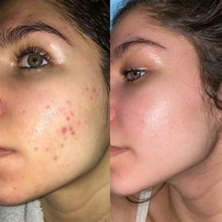 Adapalene Before and After: Transforming Your Skin with This Powerful Ingredient