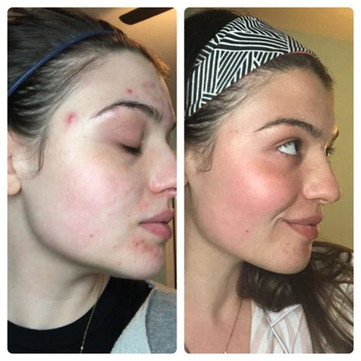 Differin Before and After: A Comprehensive Guide to Transforming Your Skin