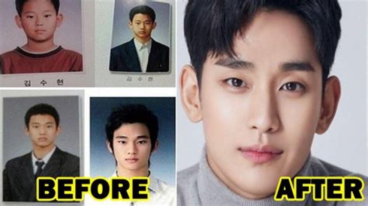 Kim Soo Hyun Plastic Surgery: Unveiling the Truth Behind the Celebrity's Transformation