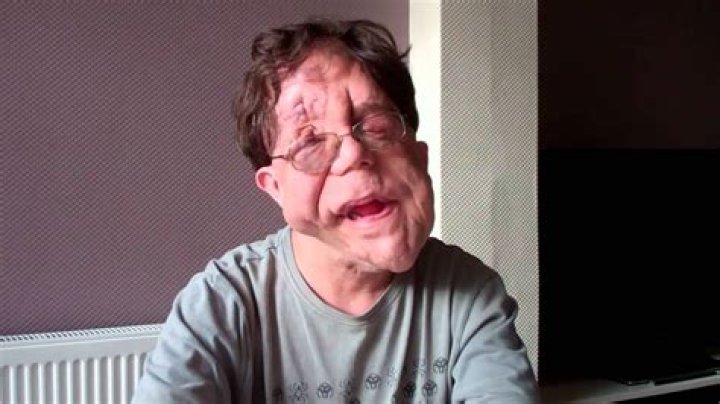 Love Story Adam Pearson and His Dedicated Wife: A Journey of Devotion