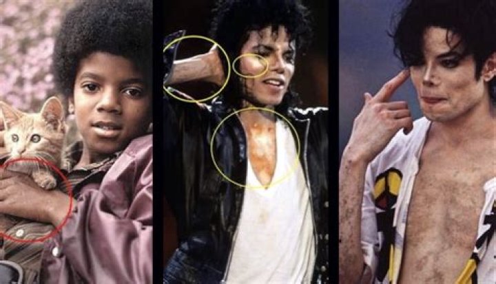 Michael Jackson Disease: Unveiling the Truth Behind the Icon's Health Struggles