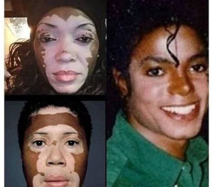 Michael Jackson Skin Bleaching: The Truth Behind the Transformation