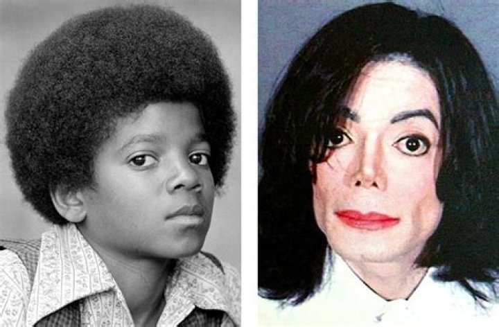 Michael Jackson Skin Condition: The Truth Behind His Transformation