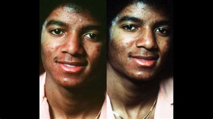 Michael Jackson Skin Disease: The Truth Behind the Transformation
