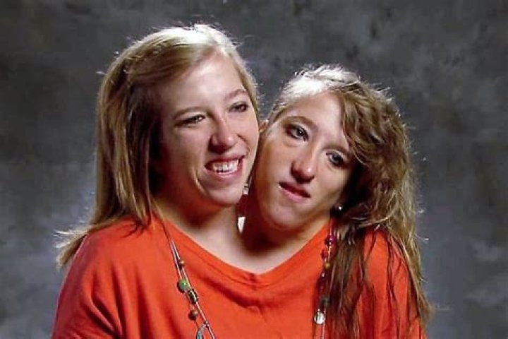 Tragic Loss: The Untimely Passing Of Conjoined Twins Abby And Brittany Hensel