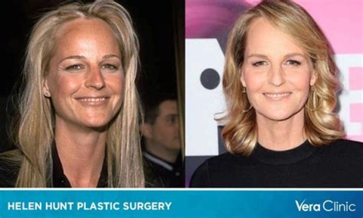Unveiling The Truth: Helen Hunt And Her Journey With Plastic Surgery