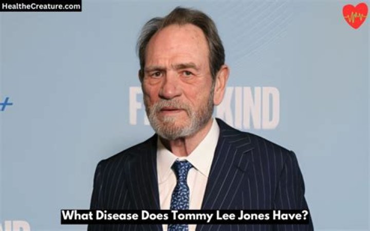 What Disease Does Tommy Lee Jones Have? A Comprehensive Guide