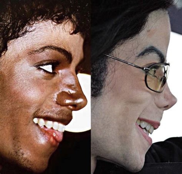 What Skin Condition Did Michael J Have? Unveiling the Truth Behind His Appearance